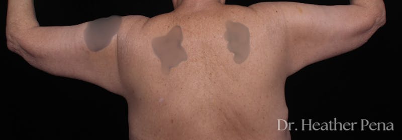 Arm Lift Before & After Gallery - Patient 536574 - Image 4