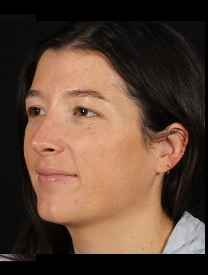 Rhinoplasty Revision Before & After Gallery - Patient 203500 - Image 8