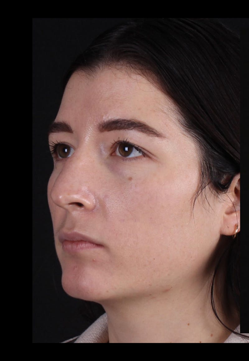 Rhinoplasty Revision Before & After Gallery - Patient 203500 - Image 7