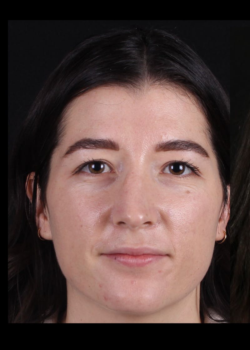 Rhinoplasty Revision Before & After Gallery - Patient 203500 - Image 3