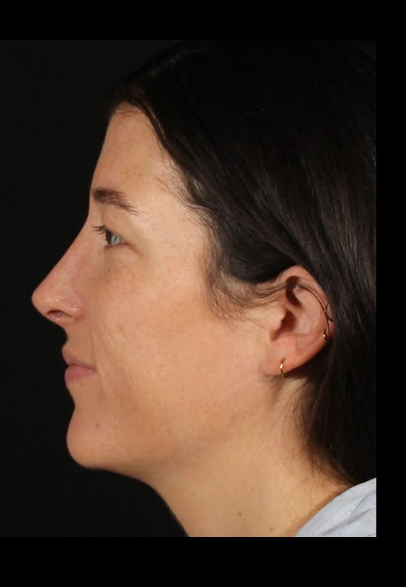 Rhinoplasty Revision Before & After Gallery - Patient 203500 - Image 2