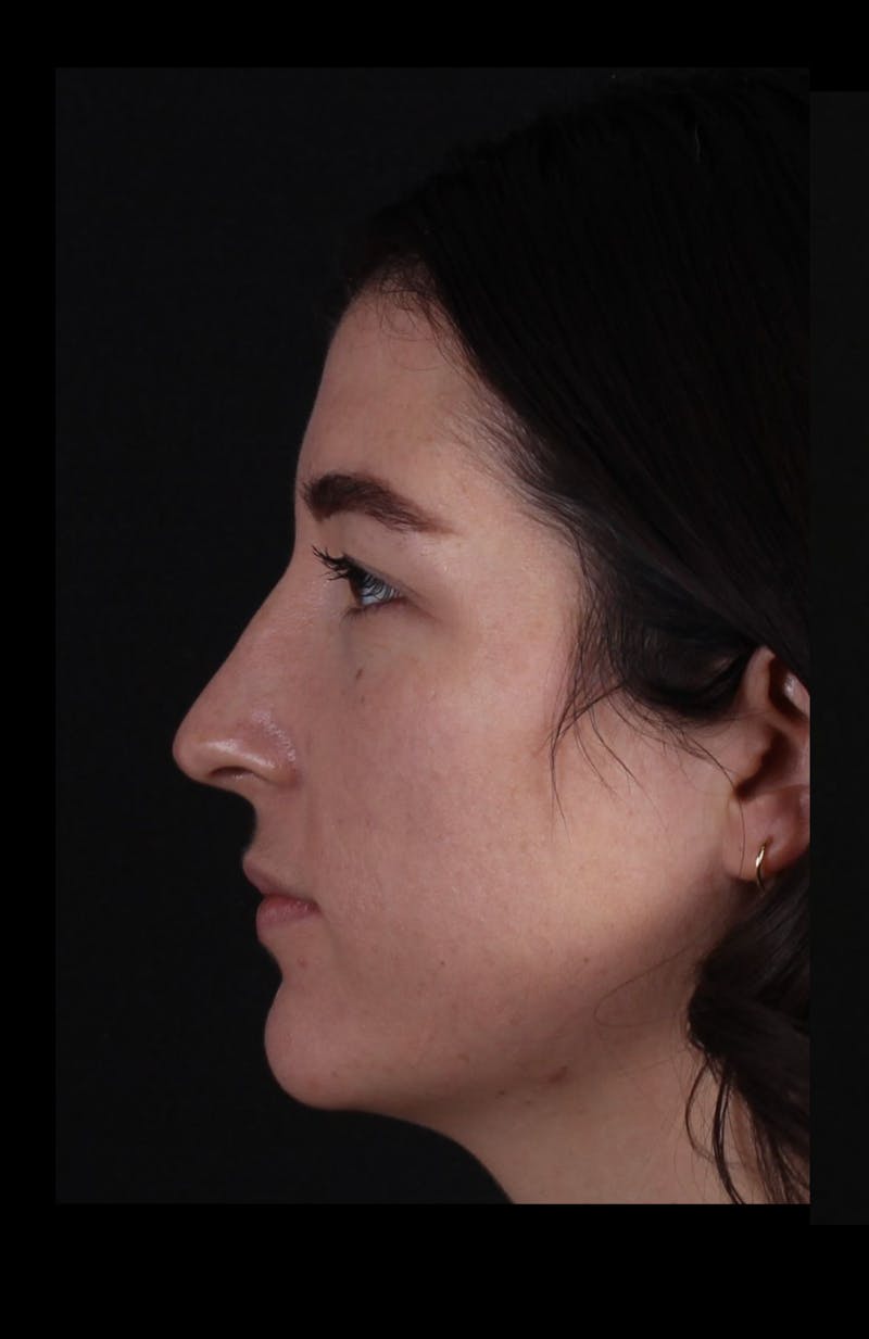 Rhinoplasty Revision Before & After Gallery - Patient 203500 - Image 1