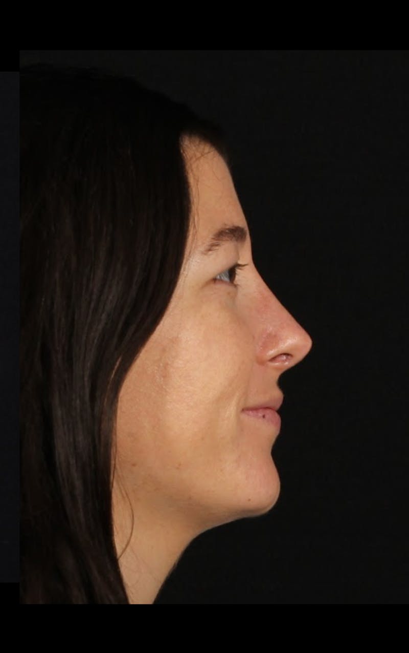 Rhinoplasty Revision Before & After Gallery - Patient 203500 - Image 6