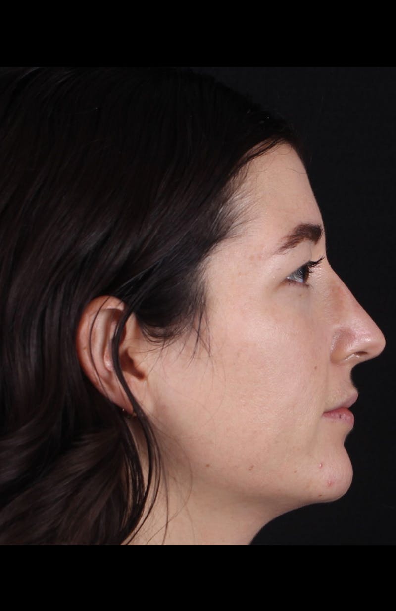 Rhinoplasty Revision Before & After Gallery - Patient 203500 - Image 5