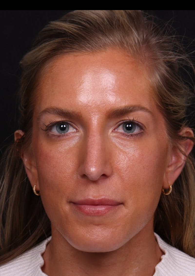 Rhinoplasty Revision Before & After Gallery - Patient 129311 - Image 3