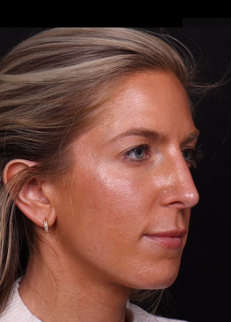 Rhinoplasty Revision Before & After Gallery - Patient 129311 - Image 5