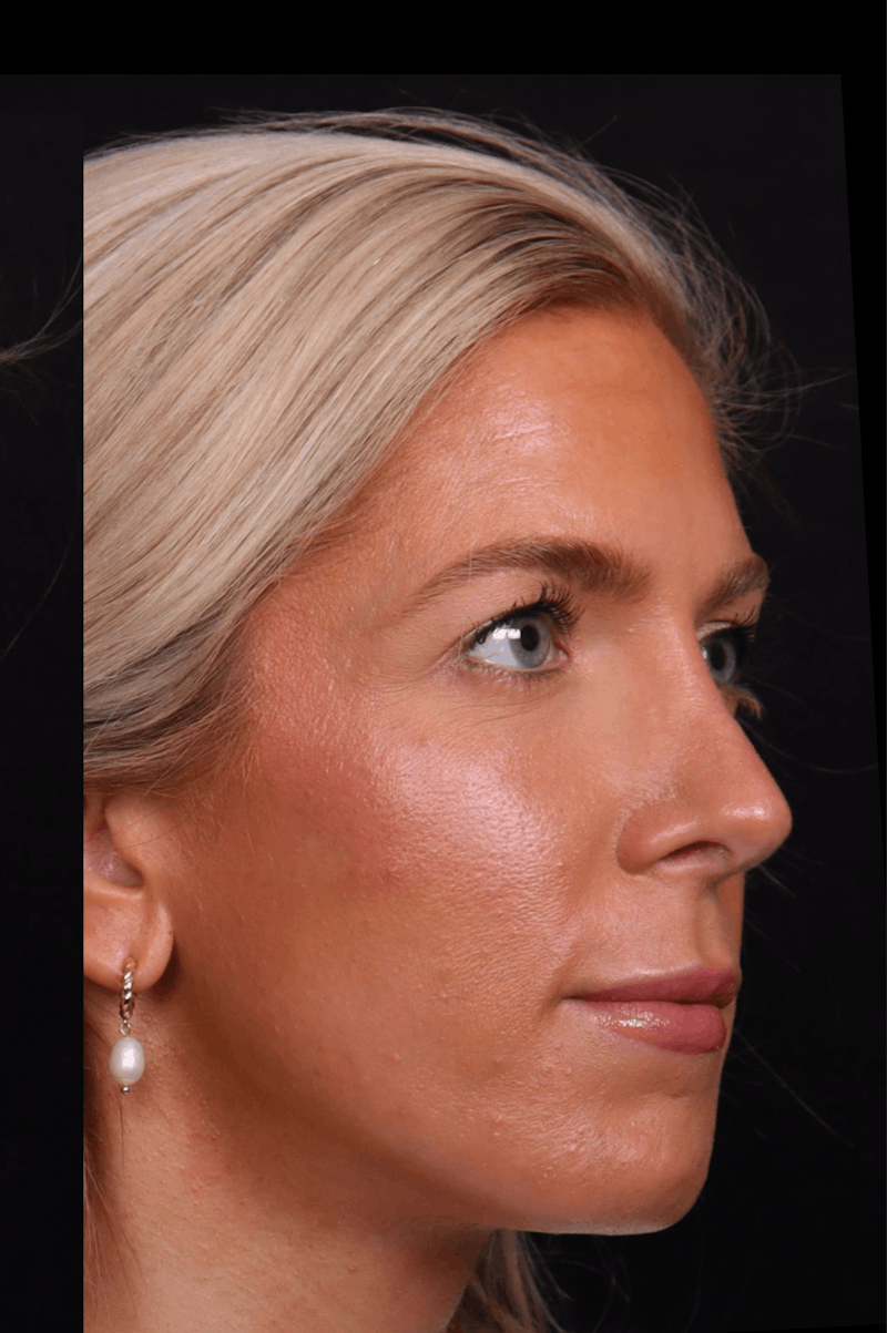 Rhinoplasty Revision Before & After Gallery - Patient 129311 - Image 6