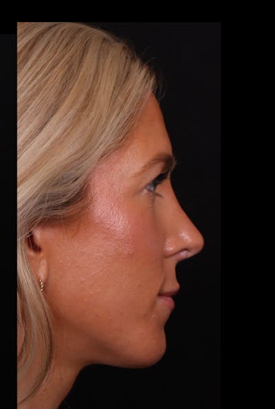 Rhinoplasty Revision Before & After Gallery - Patient 129311 - Image 2
