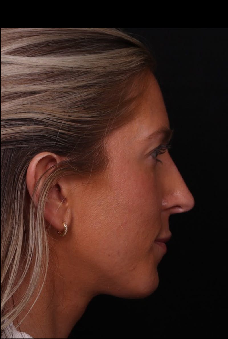 Rhinoplasty Revision Before & After Gallery - Patient 129311 - Image 1