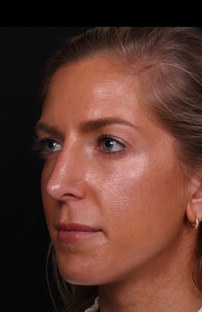 Rhinoplasty Revision Before & After Gallery - Patient 129311 - Image 9