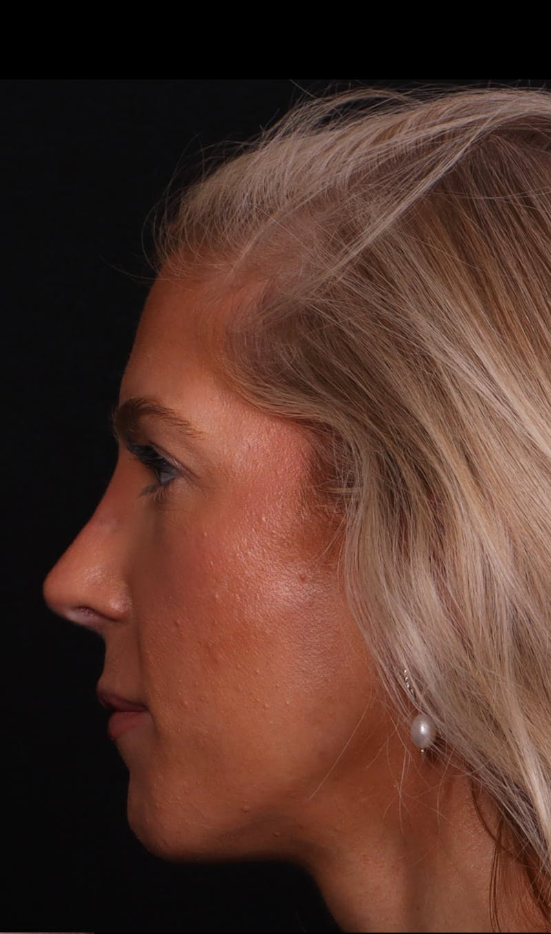 Rhinoplasty Revision Before & After Gallery - Patient 129311 - Image 8