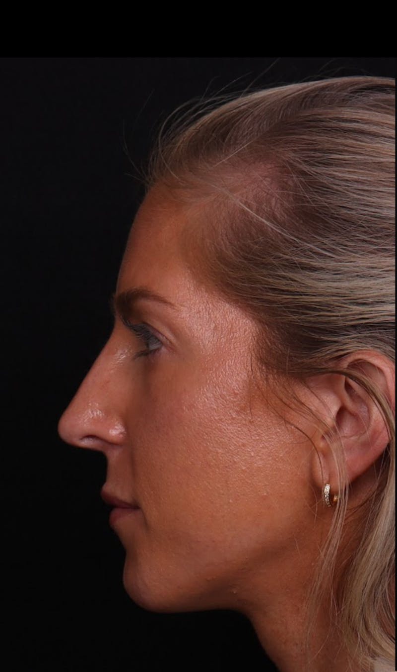 Rhinoplasty Revision Before & After Gallery - Patient 129311 - Image 7