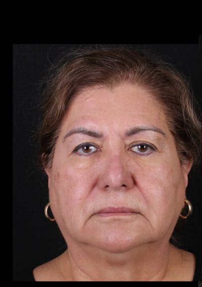 Rhinoplasty Revision Before & After Gallery - Patient 243227 - Image 1