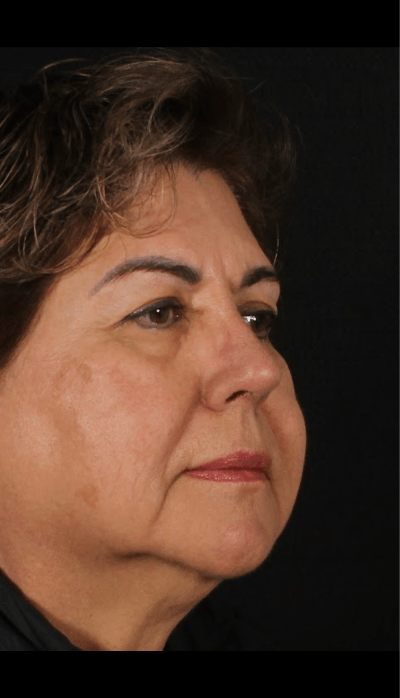 Rhinoplasty Revision Before & After Gallery - Patient 243227 - Image 4