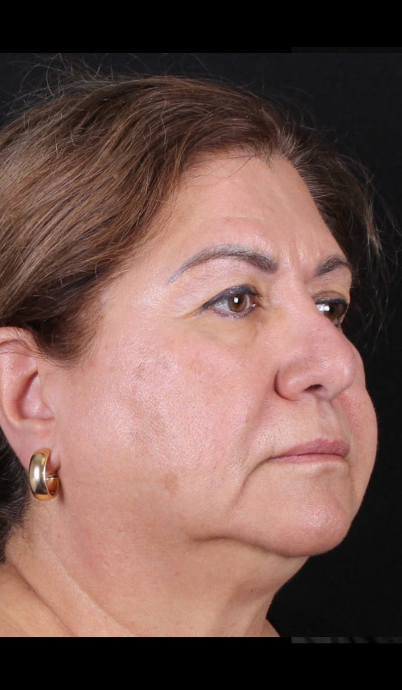 Rhinoplasty Revision Before & After Gallery - Patient 243227 - Image 3