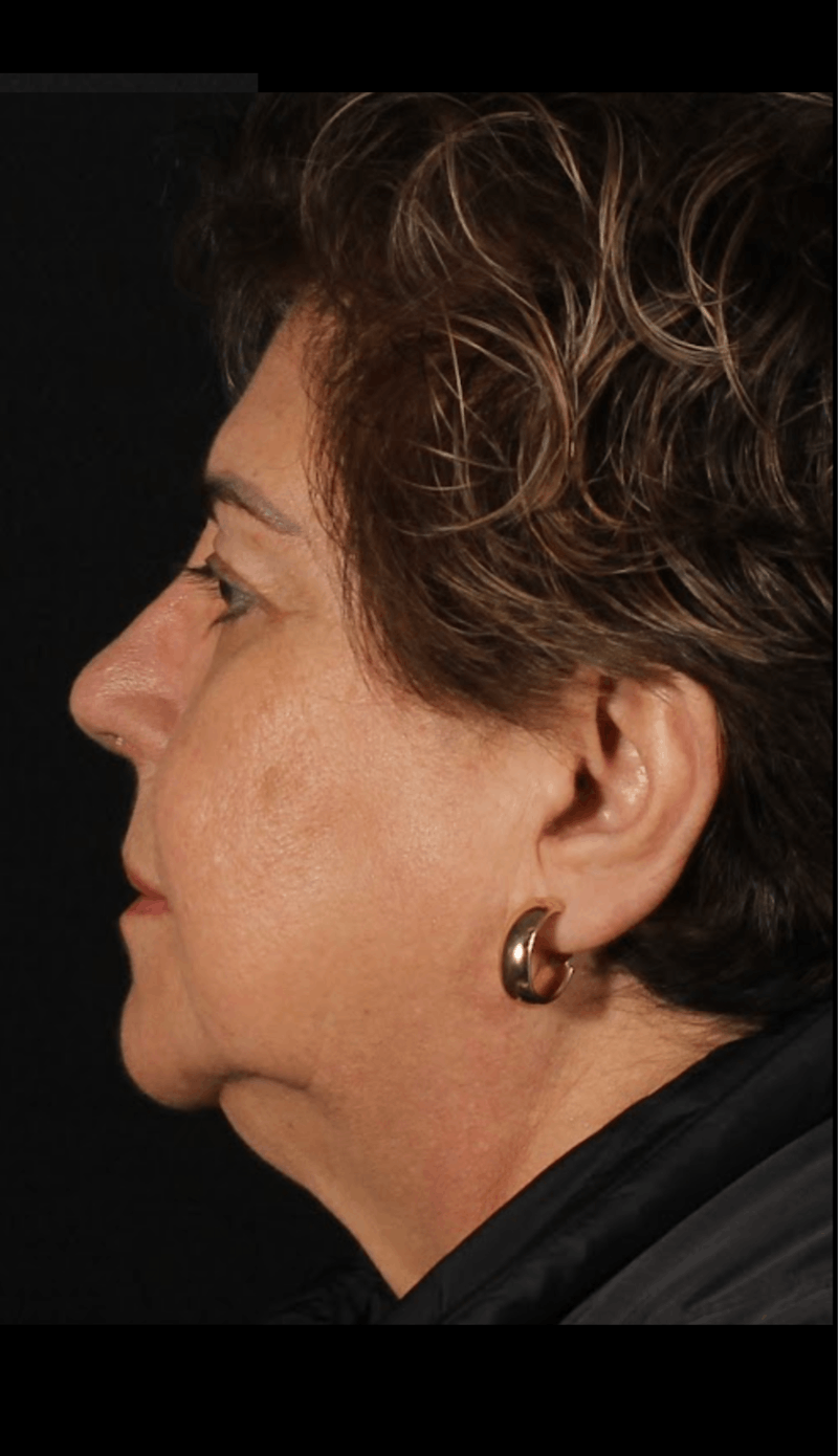 Rhinoplasty Revision Before & After Gallery - Patient 243227 - Image 6