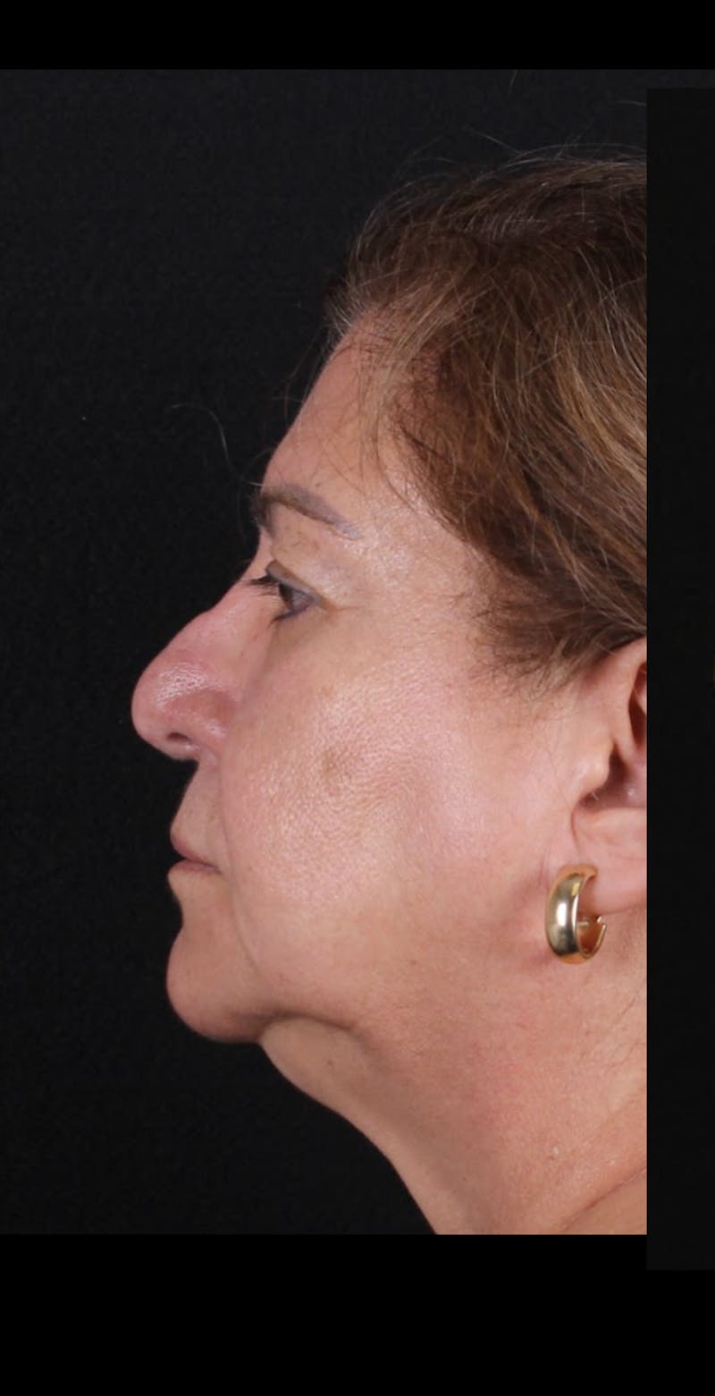 Rhinoplasty Revision Before & After Gallery - Patient 243227 - Image 5