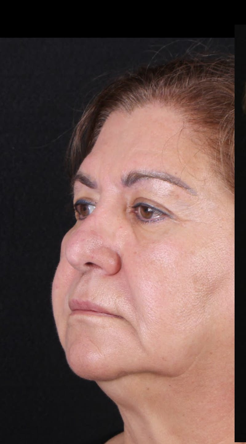 Rhinoplasty Revision Before & After Gallery - Patient 243227 - Image 7