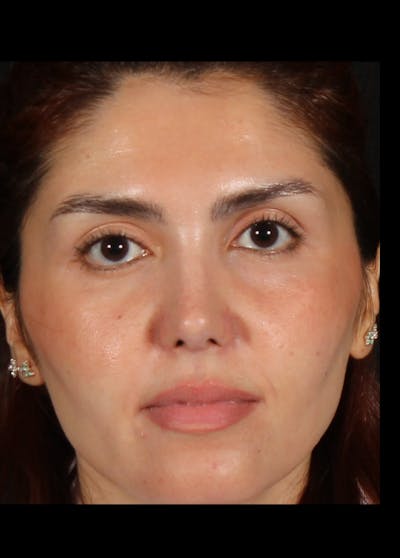 Rhinoplasty Revision Before & After Gallery - Patient 103849 - Image 2
