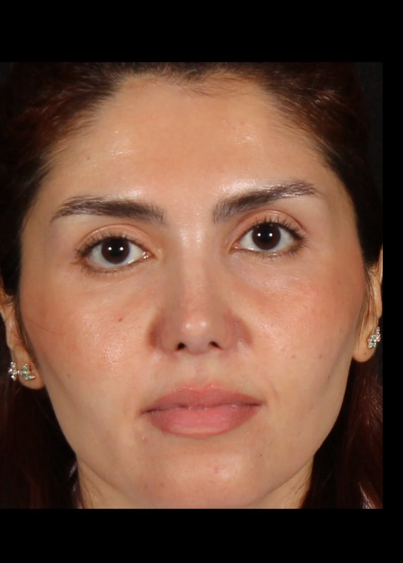 Rhinoplasty Revision Before & After Gallery - Patient 103849 - Image 2