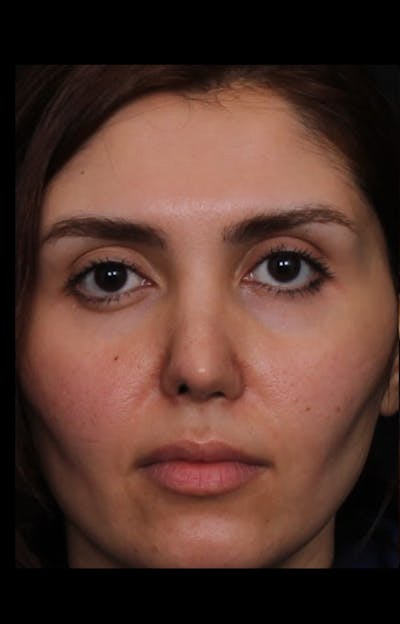 Rhinoplasty Revision Before & After Gallery - Patient 103849 - Image 1