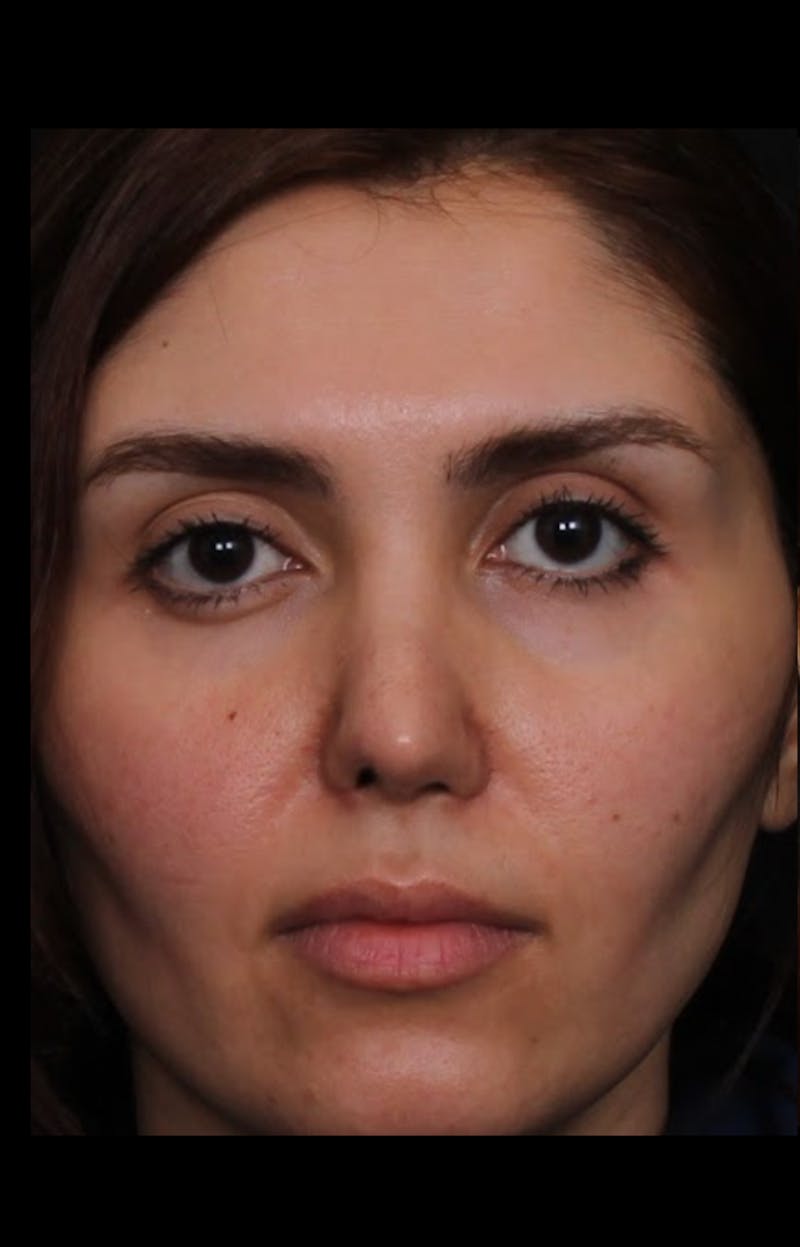 Rhinoplasty Revision Before & After Gallery - Patient 103849 - Image 1
