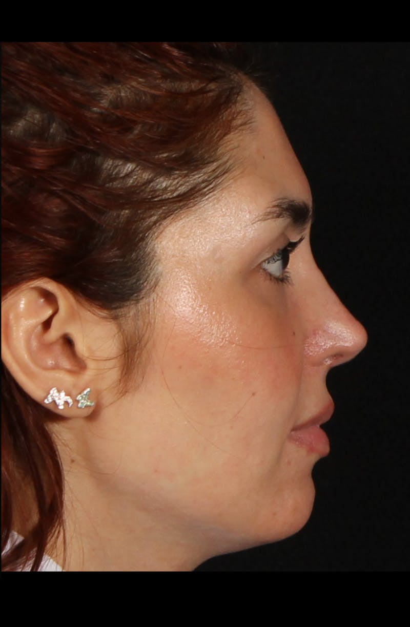 Rhinoplasty Revision Before & After Gallery - Patient 103849 - Image 4