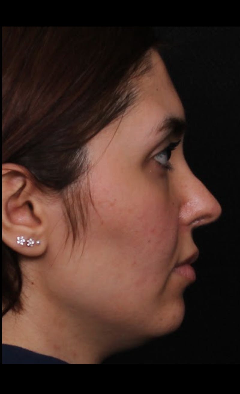 Rhinoplasty Revision Before & After Gallery - Patient 103849 - Image 3