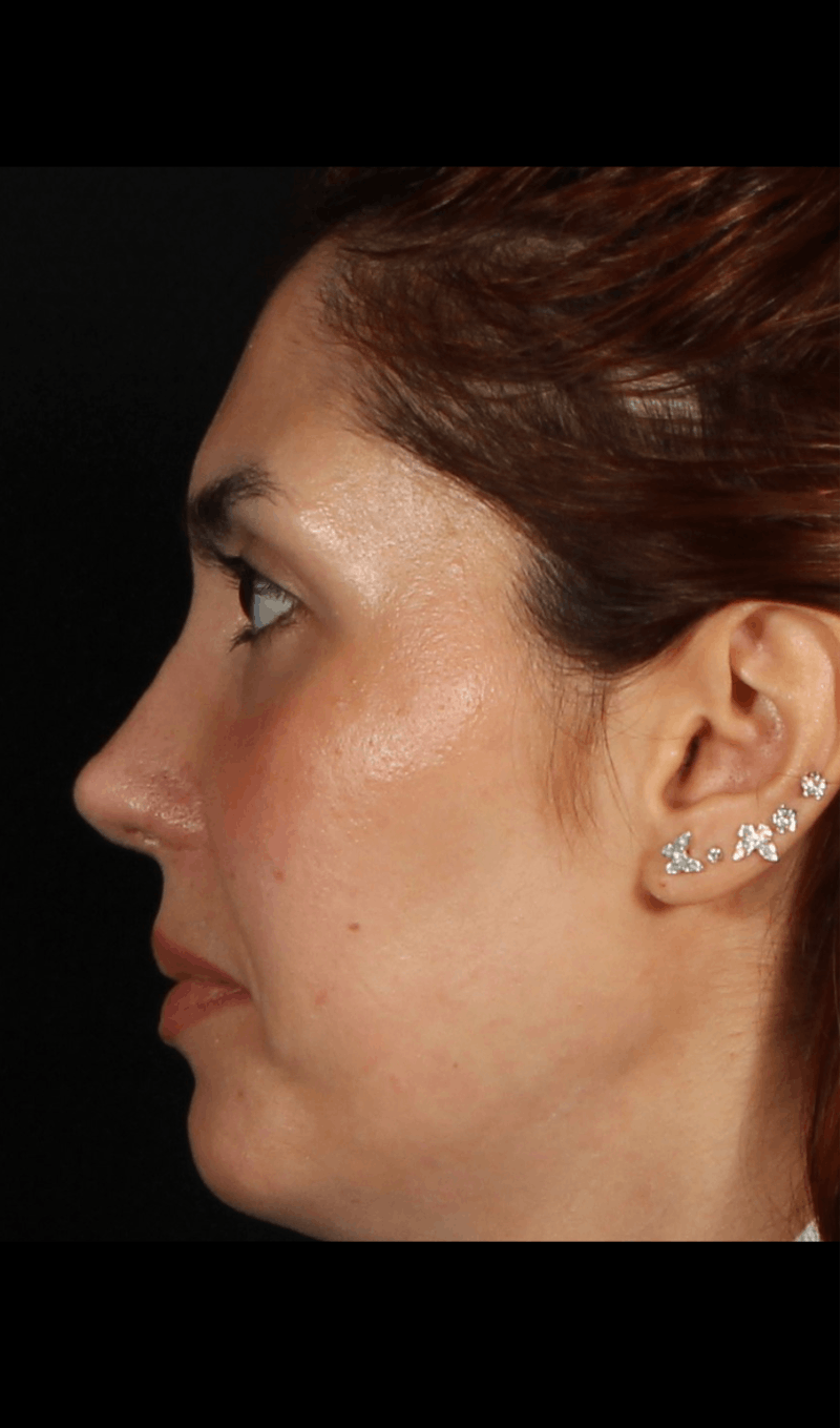 Rhinoplasty Revision Before & After Gallery - Patient 103849 - Image 6