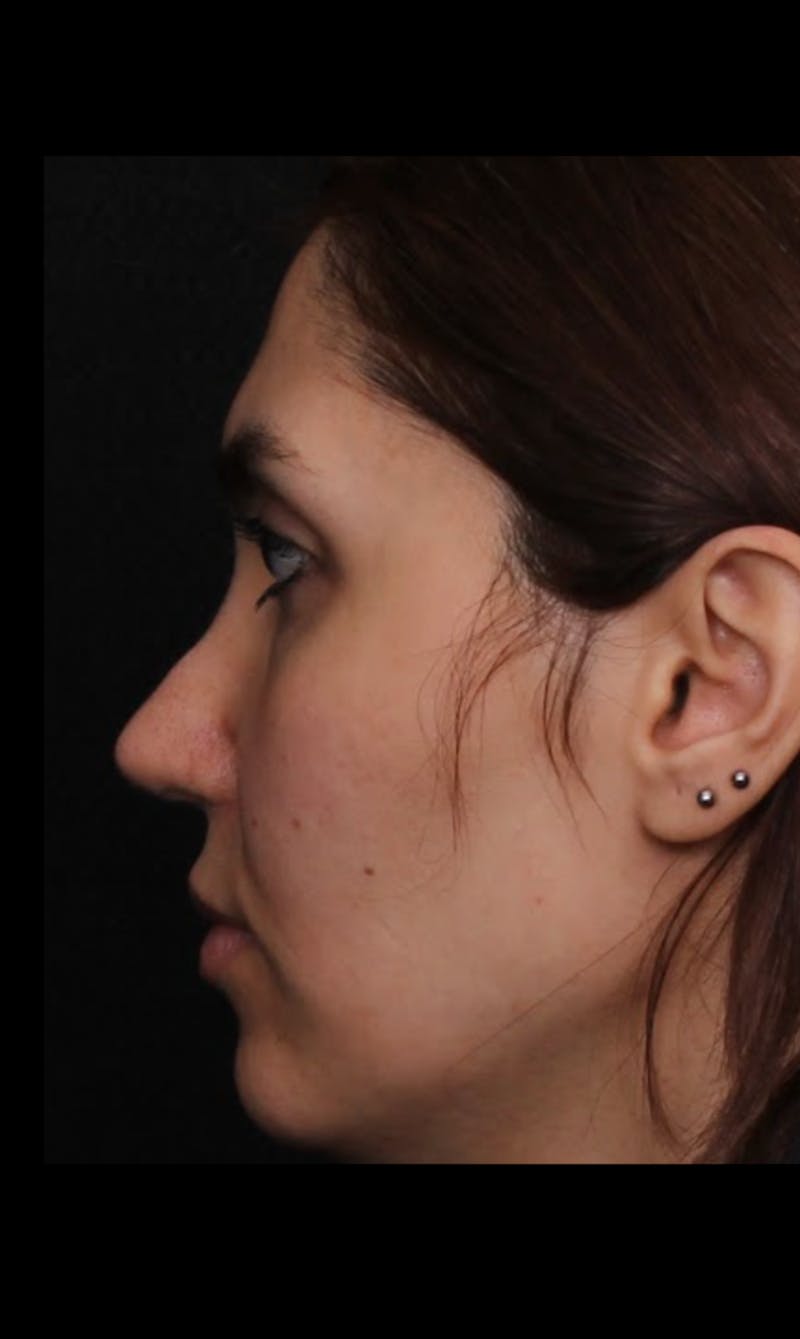 Rhinoplasty Revision Before & After Gallery - Patient 103849 - Image 5