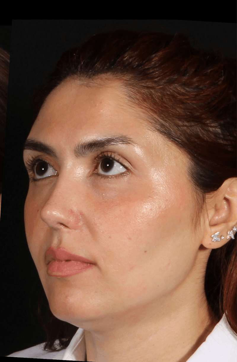 Rhinoplasty Revision Before & After Gallery - Patient 103849 - Image 8