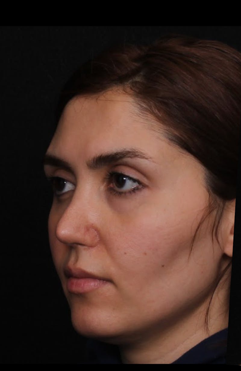 Rhinoplasty Revision Before & After Gallery - Patient 103849 - Image 7