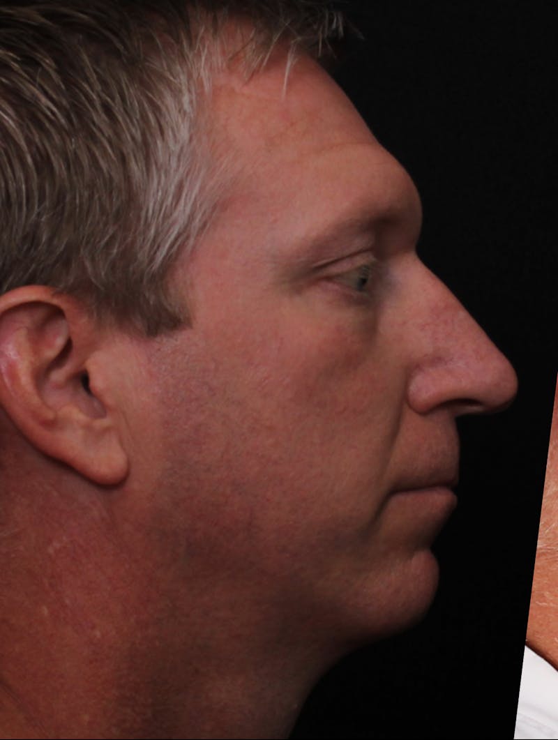 Rhinoplasty Male Before & After Gallery - Patient 718181 - Image 3