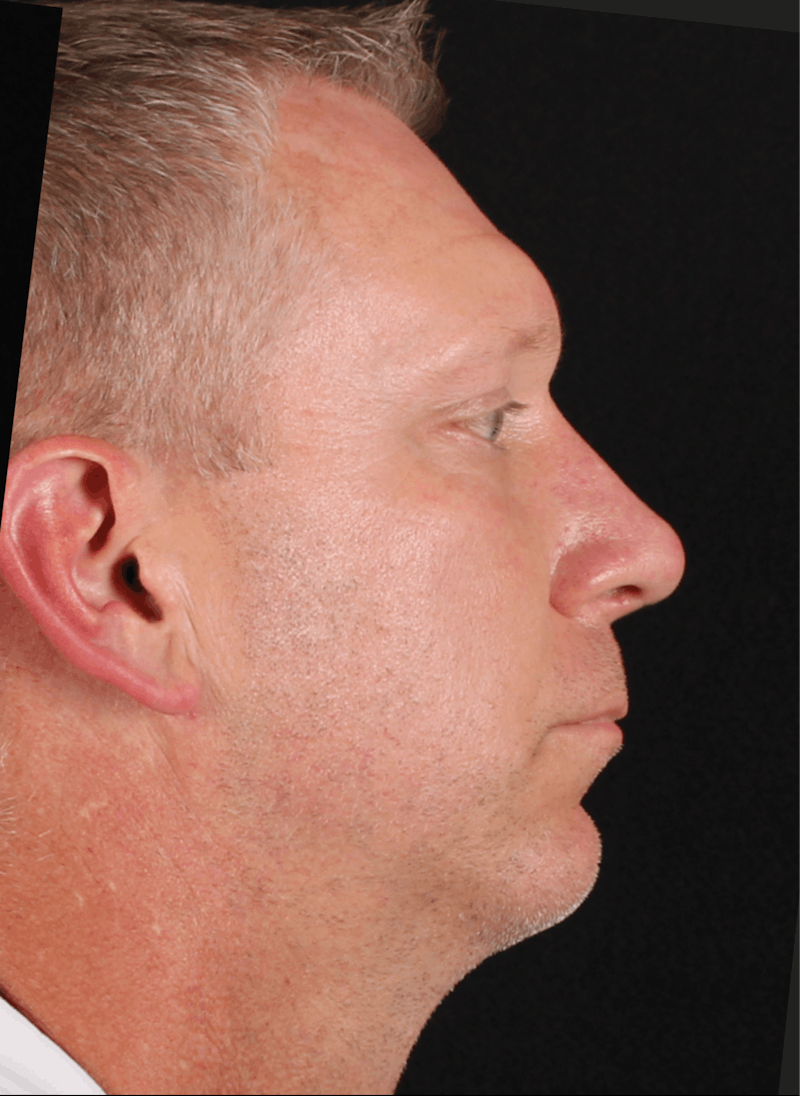 Rhinoplasty Male Before & After Gallery - Patient 718181 - Image 4