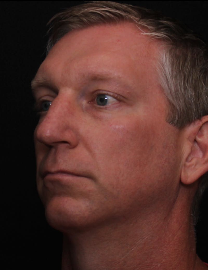 Rhinoplasty Male Before & After Gallery - Patient 718181 - Image 9