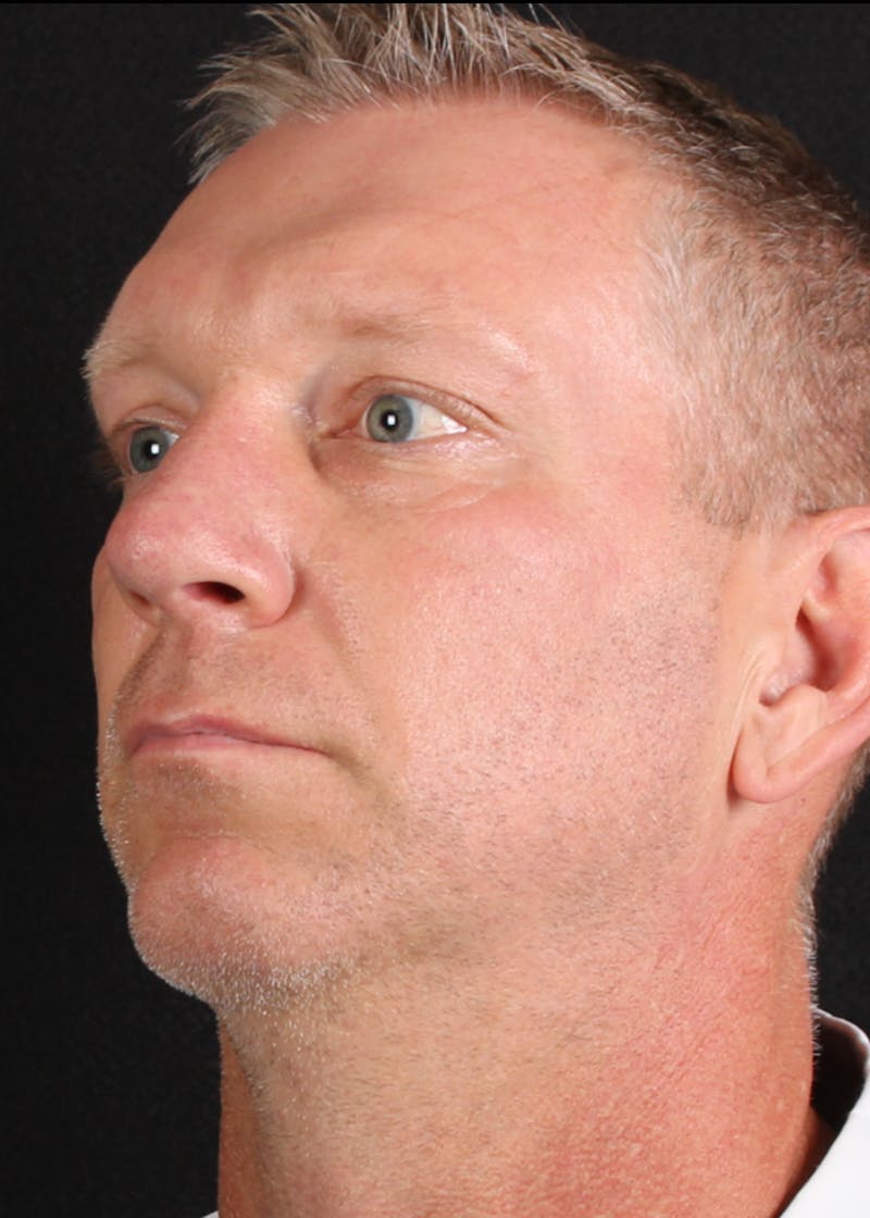 Rhinoplasty Male Before & After Gallery - Patient 718181 - Image 10