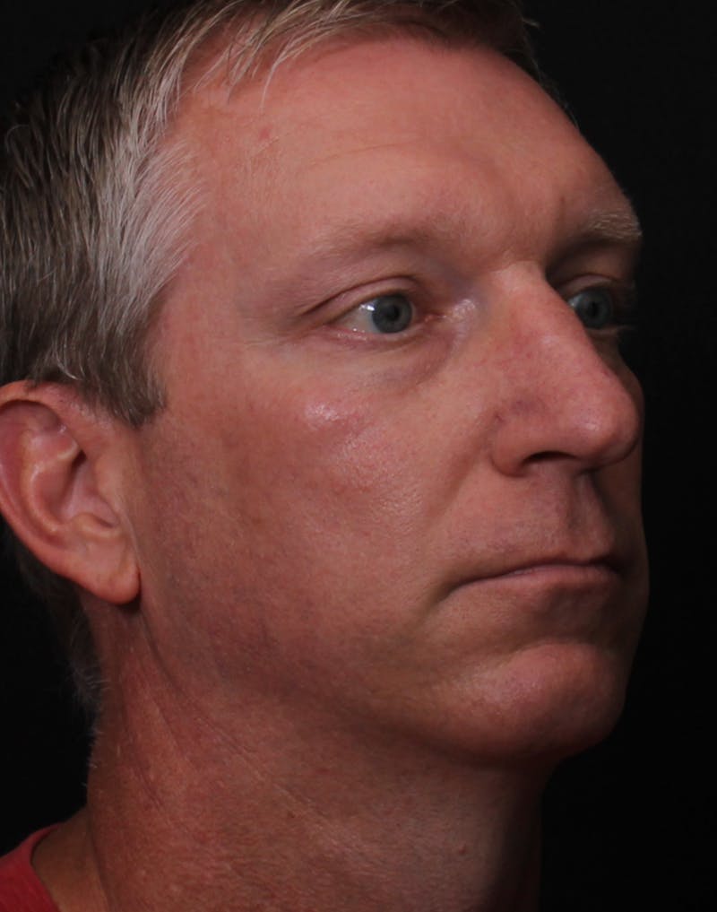 Rhinoplasty Male Before & After Gallery - Patient 718181 - Image 7