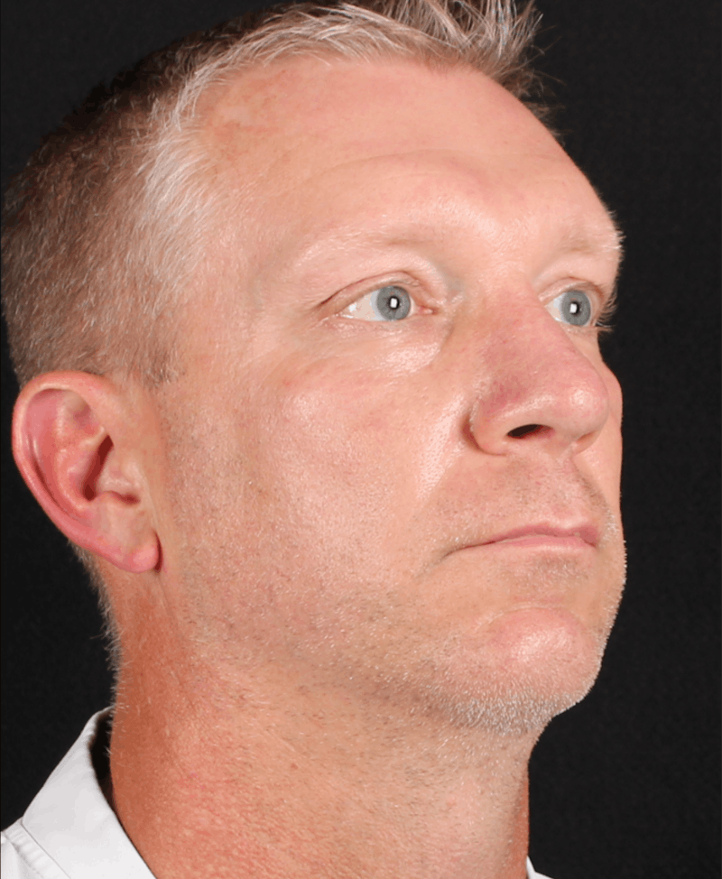 Rhinoplasty Male Before & After Gallery - Patient 718181 - Image 8