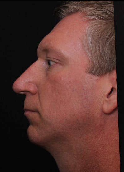 Rhinoplasty Male Before & After Gallery - Patient 718181 - Image 1