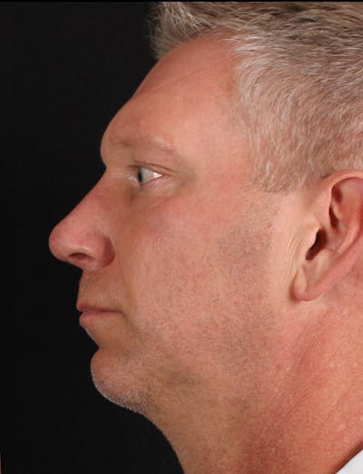 Rhinoplasty Male Before & After Gallery - Patient 718181 - Image 2