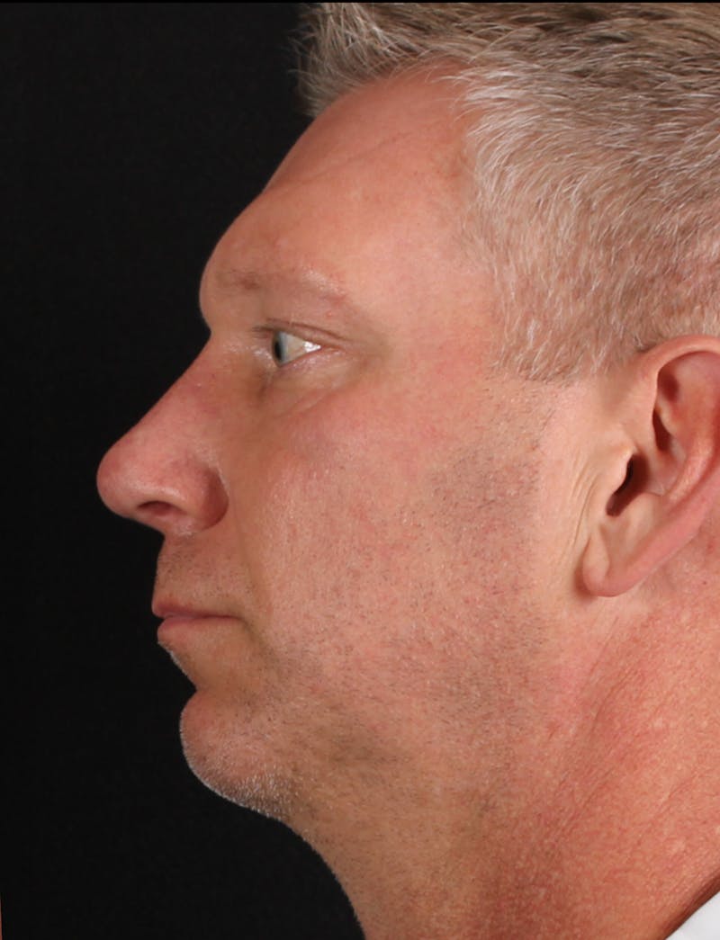 Rhinoplasty Male Before & After Gallery - Patient 718181 - Image 2