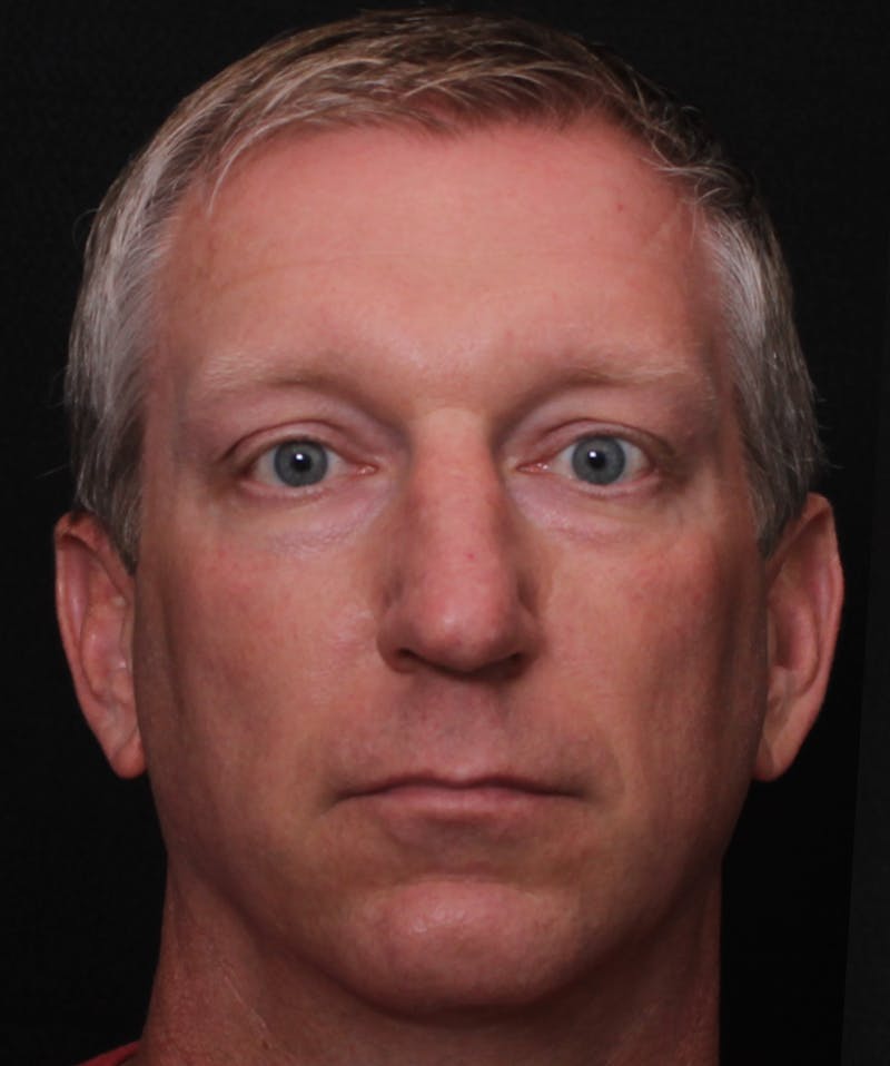 Rhinoplasty Male Before & After Gallery - Patient 718181 - Image 5