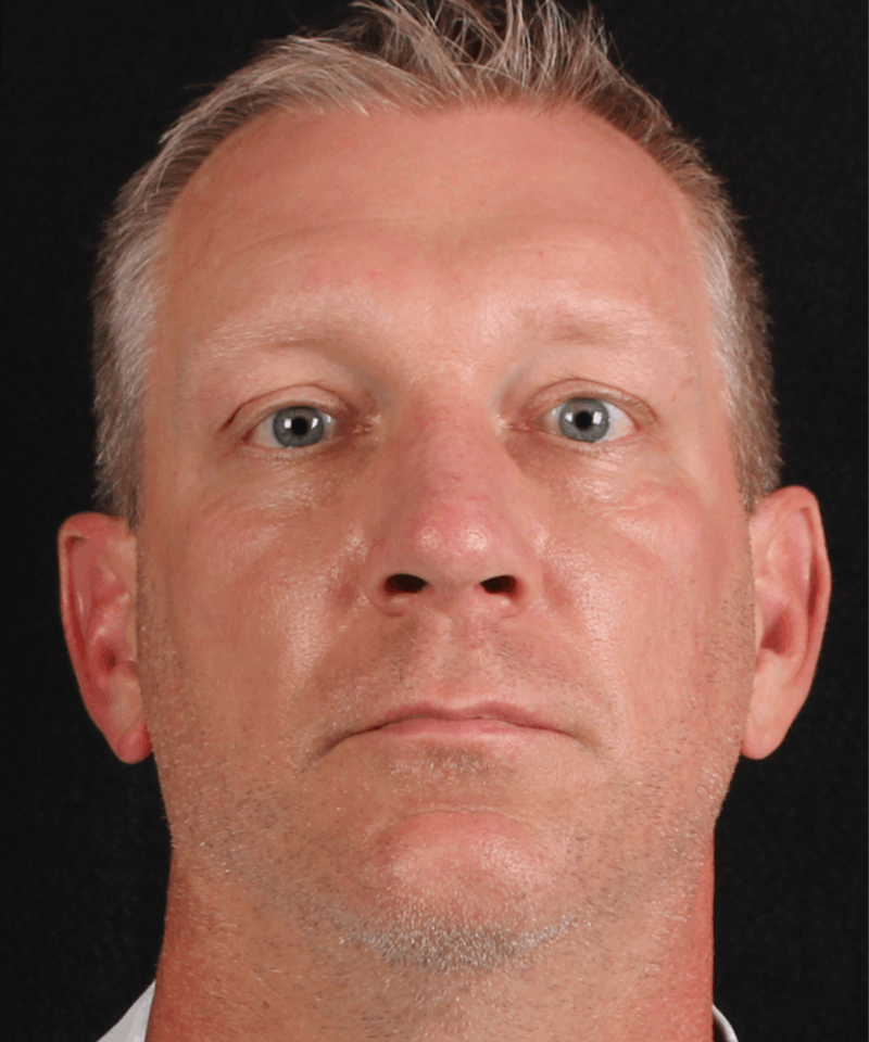 Rhinoplasty Male Before & After Gallery - Patient 718181 - Image 6