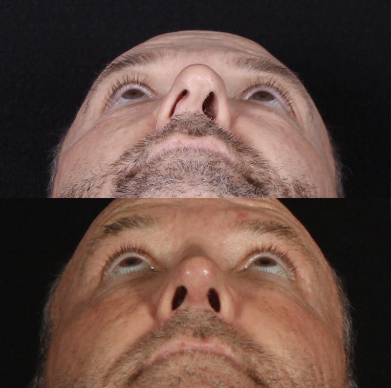 Rhinoplasty Male Before & After Gallery - Patient 109349 - Image 11