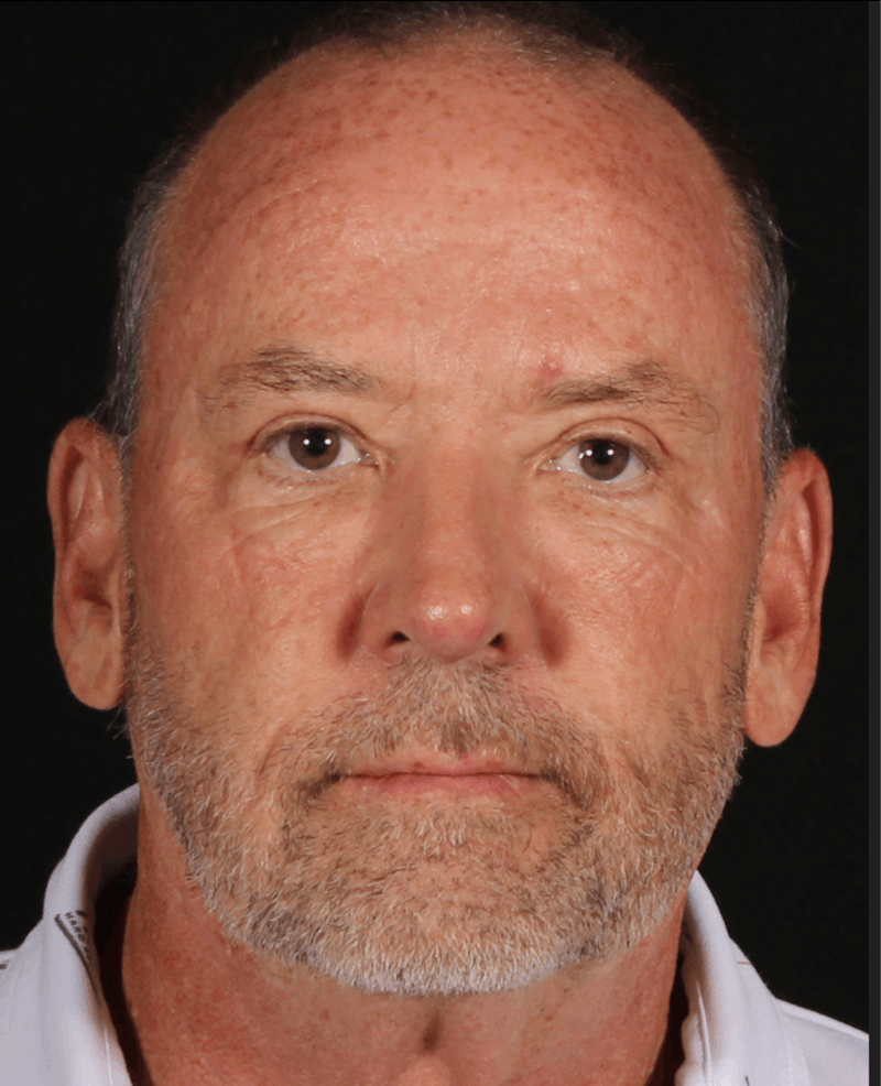 Rhinoplasty Male Before & After Gallery - Patient 109349 - Image 4