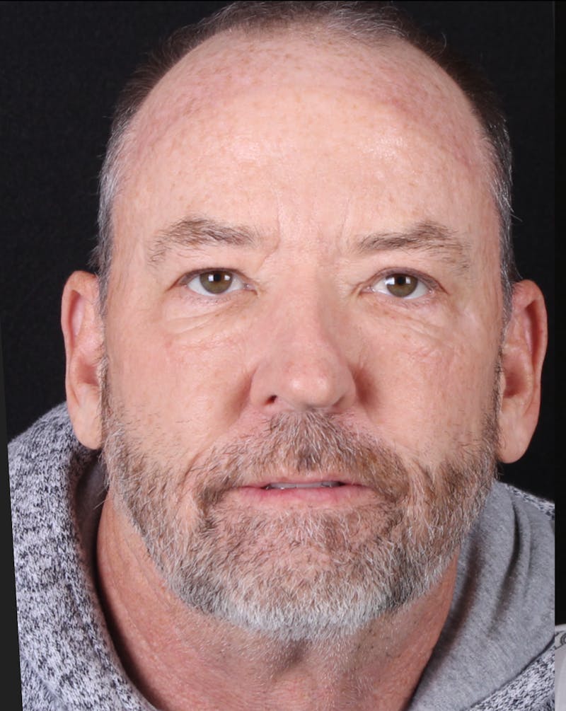 Rhinoplasty Male Before & After Gallery - Patient 109349 - Image 3