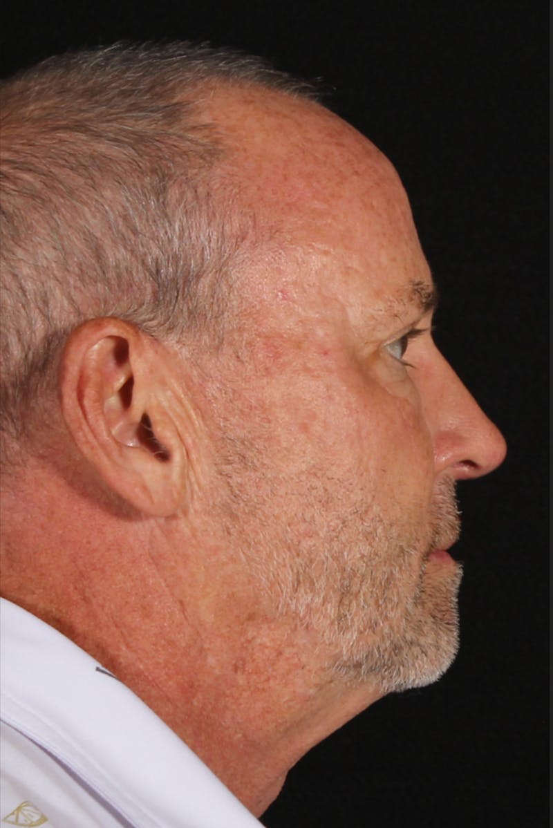 Rhinoplasty Male Before & After Gallery - Patient 109349 - Image 2