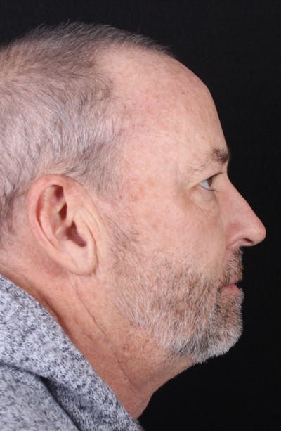Rhinoplasty Male Before & After Gallery - Patient 109349 - Image 1