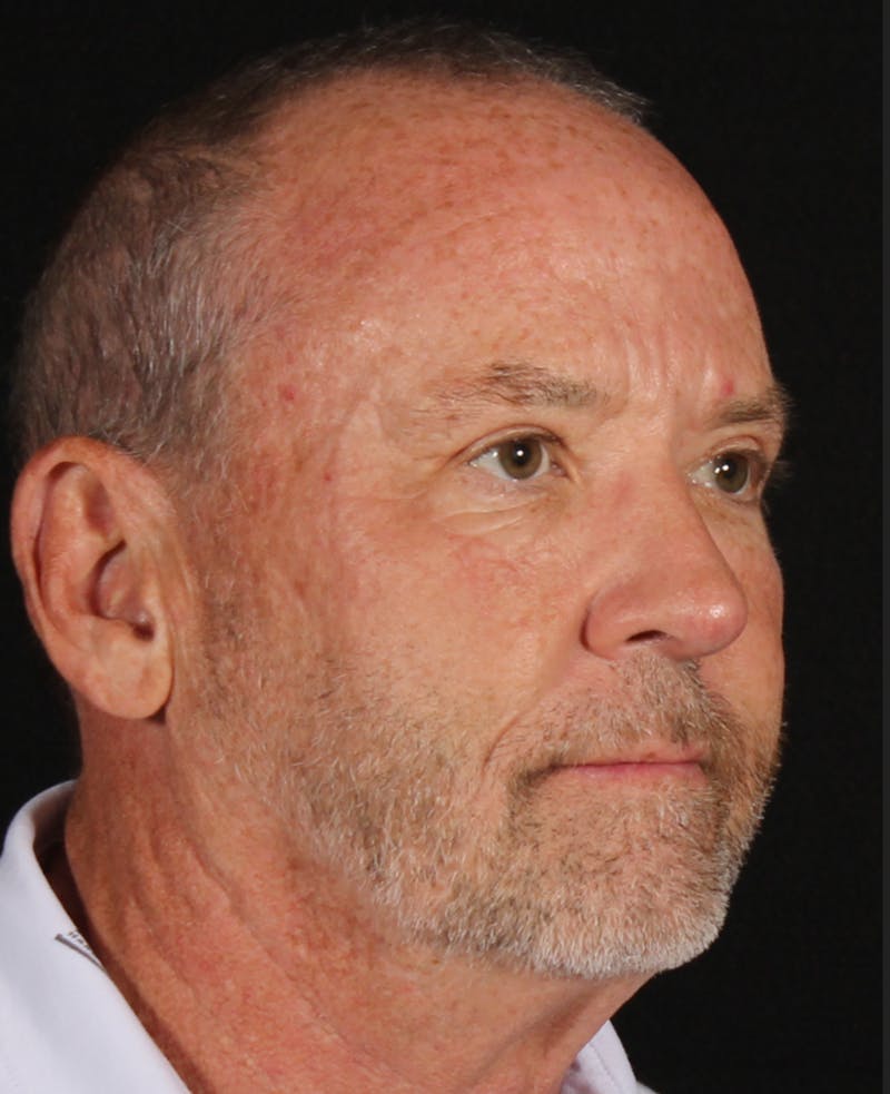 Rhinoplasty Male Before & After Gallery - Patient 109349 - Image 6