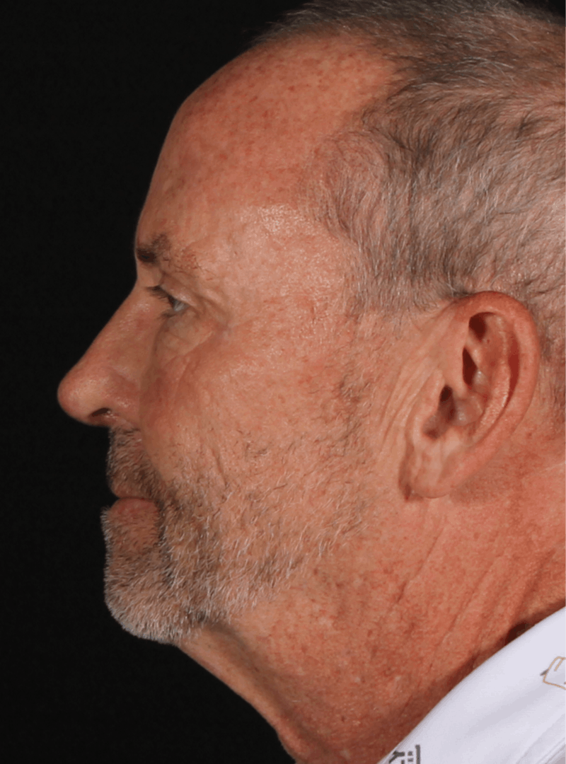 Rhinoplasty Male Before & After Gallery - Patient 109349 - Image 8